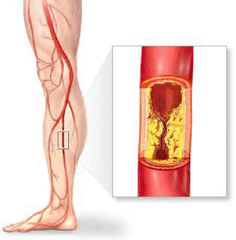 Атеросклеротические атеросклеротические поражения конечностей