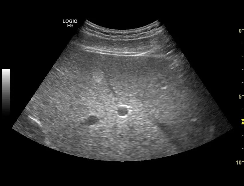 Гиперэхогенное образование в печени по УЗИ. Метастатическое поражение печени УЗИ. Округлые образования печени