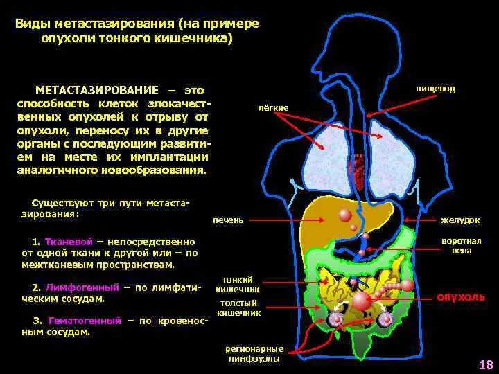 Пути метастазирования рака. Пути метастазирования злокачественных опухолей. Схема метастазирования опухоли. Основные пути метастазирования опухолей. Схемы метастазирования от различных органов.