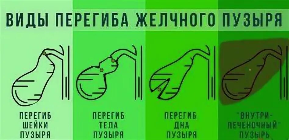 Перегиб желчного что это