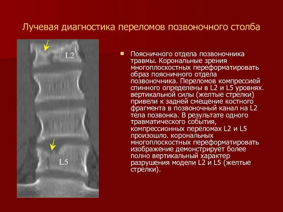 Последствие перелома позвоночника мкб. Компрессионный перелом позвоночника th-5-6. Компрессионный перелом позвоночника грудного отдела заключение. Компрессионный перелом позвоночника 5 крестцового. Краевой перелом позвонка поясничного отдела.