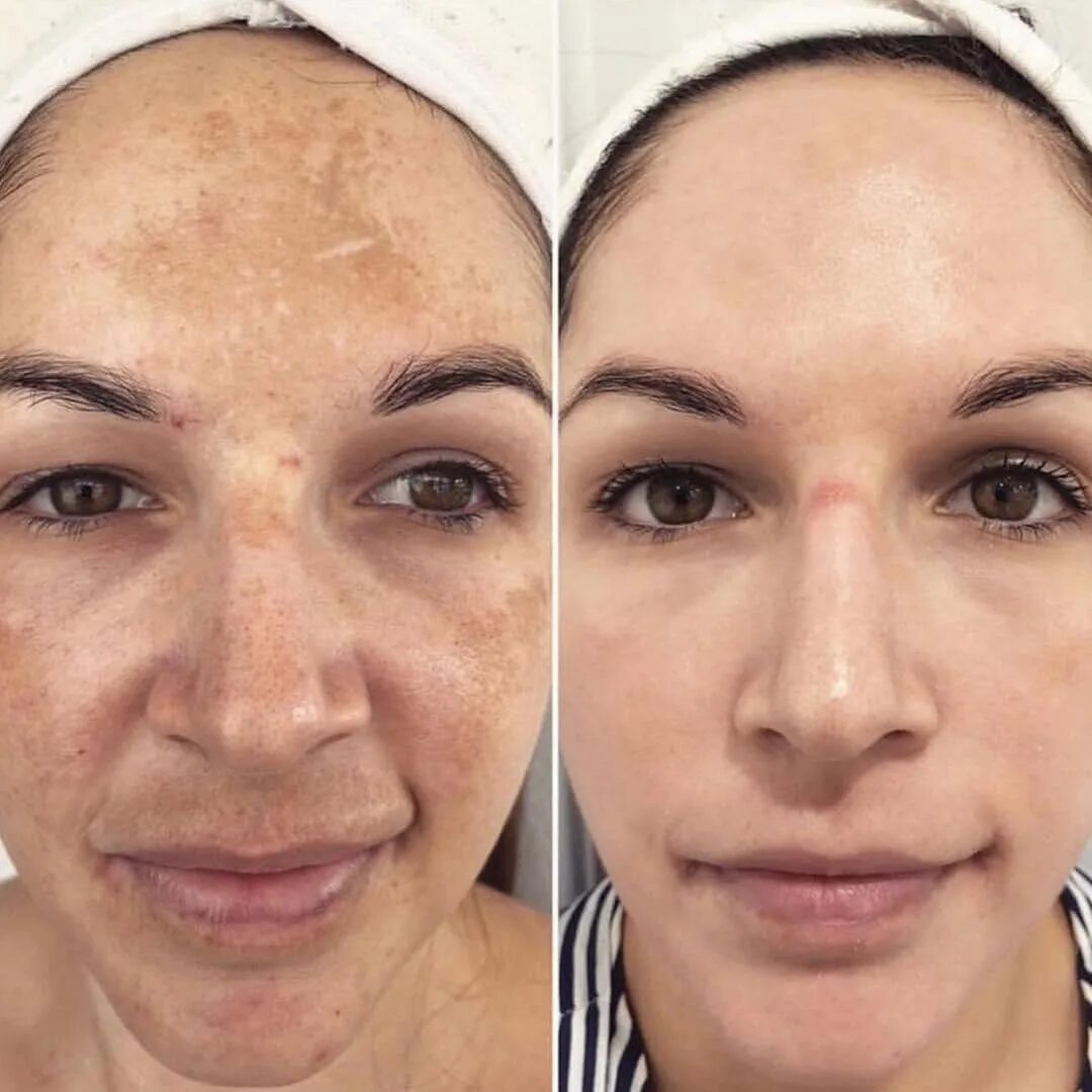 Пилинг 50 лет. Dermamelan cosmelan. cosmelan peeling от mesoestetic. пилинг mesoestetic tca 50%.