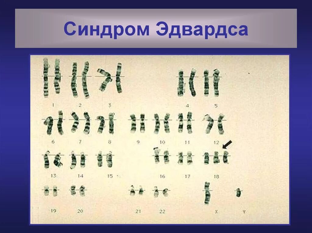 Синдром эдвардса клинические проявления. Синдром эдвардса (трисомия 18). Клинические симптомы синдрома эдвардса. Идеограмма синдром эдвардса. Синдром эдвардса это.