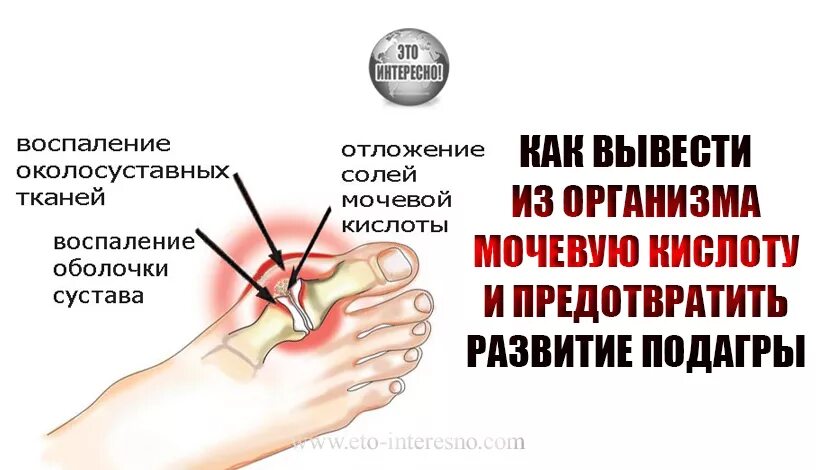 Вывести мочевую кислоту из организма народными средствами. Мочевая кислота пути выведения из организма. Отложение солей мочевой кислоты в суставах. Мочевая кислота в колене. Вывод мочевой кислоты из организма.