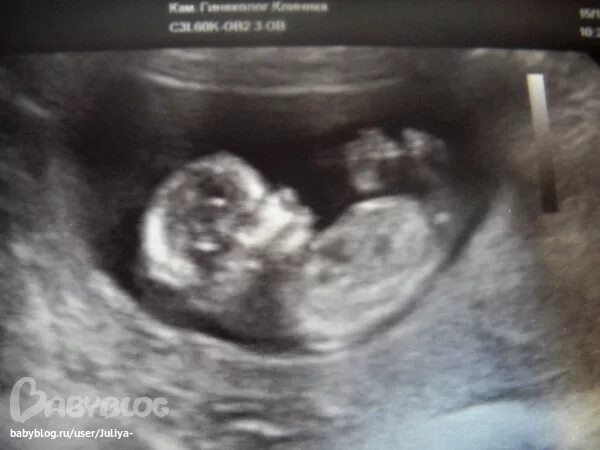 34 неделя беременности тазовое предлежание. Положение плода продольное предлежание тазовое. Тазовое предлежание плода узи. Центральное предлежание плаценты. Краевое предлежание плаценты кровотечение.