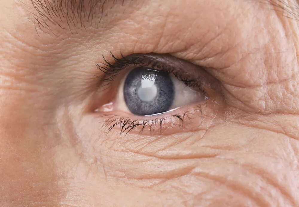 Миопизирующая катаракта. Пресенильная катаракта. Глазные болезни: глаукома, катаракта. Бельмо катаракта глаукома.