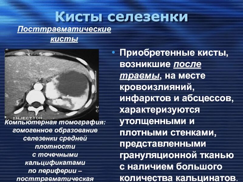 Обызвествленная киста селезенки кт. Кисты селезенки гистология. Паразитарная киста селезенки на кт.