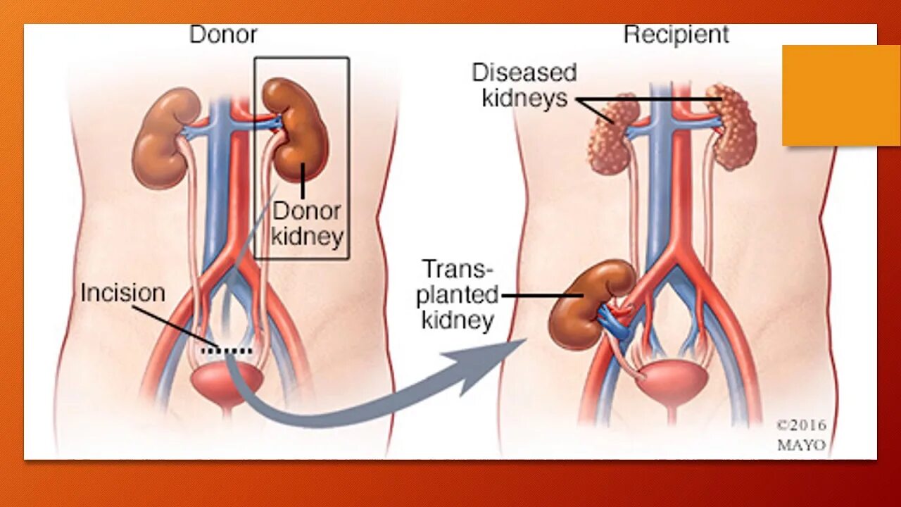 Трансплантация почки схема. Трансплантация донорской почки. Операция пересадки почки. Гетеротопическая пересадка почки. Реципиент трансплантация
