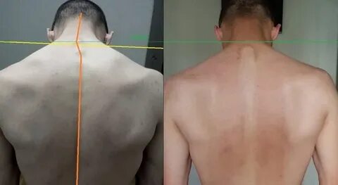 Сколиоз шейного отдела