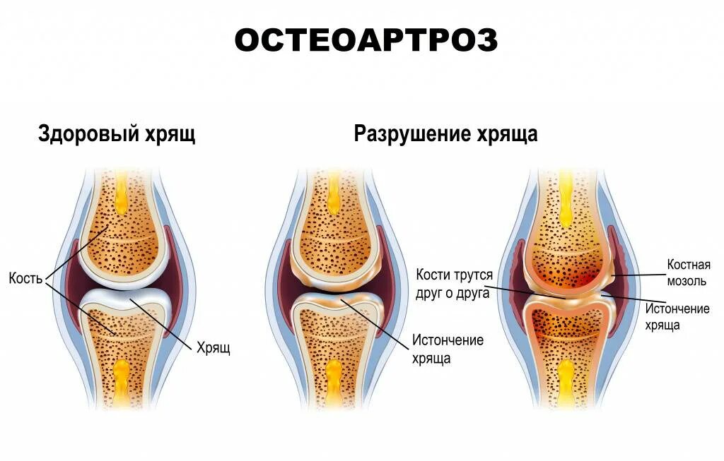 Остеоартрит и остеоартроз. • Остеоартрит (разрушение суставов);.