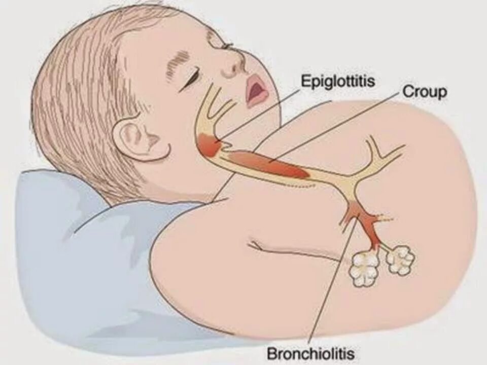 Эпиглоттит симптомы. Гемофильная инфекция эпиглоттит. Круп заболевание у детей.