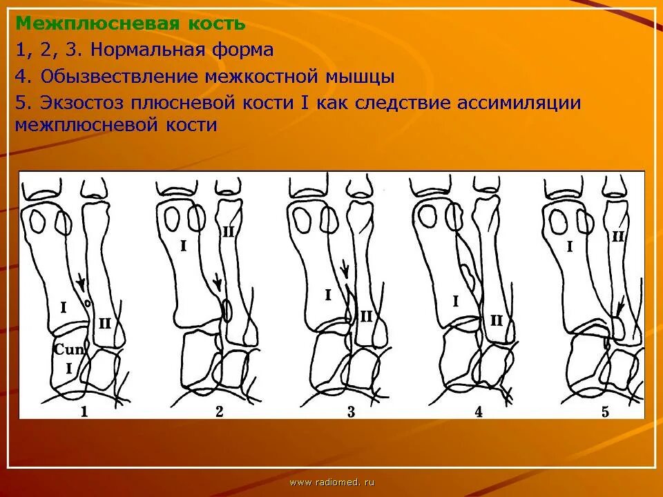 Развитие нижней конечности. Аномалии развития стопы. Аномалия развития нижних конечностей. Аномалии развития стопы у детей. Аномалии развития костей нижних конечностей.