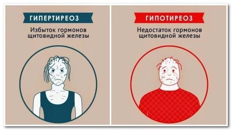 Повышенный ттг гипертиреоз. Повышение гормонов щитовидной железы. Пониженный уровень гормонов щитовидной железы. Низкие гормоны щитовидной железы симптомы. ТТГ понижен у женщин симптомы.