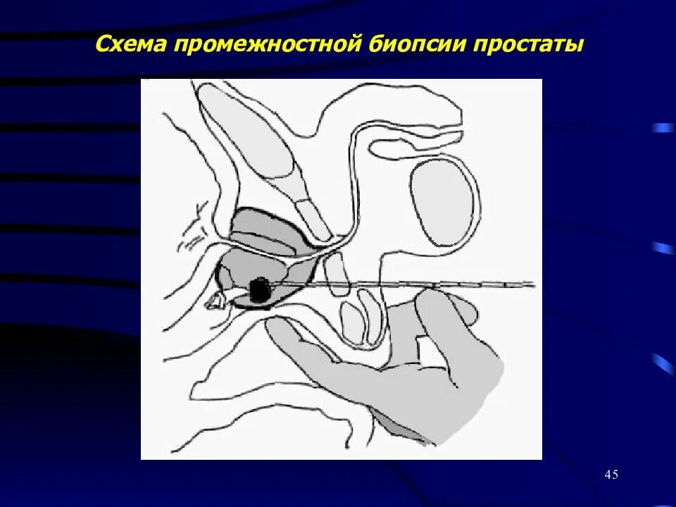 Схема простаты. Простата схема. Простата схема расположения. Промежностная биопсия простаты. Схема биопсии простаты.