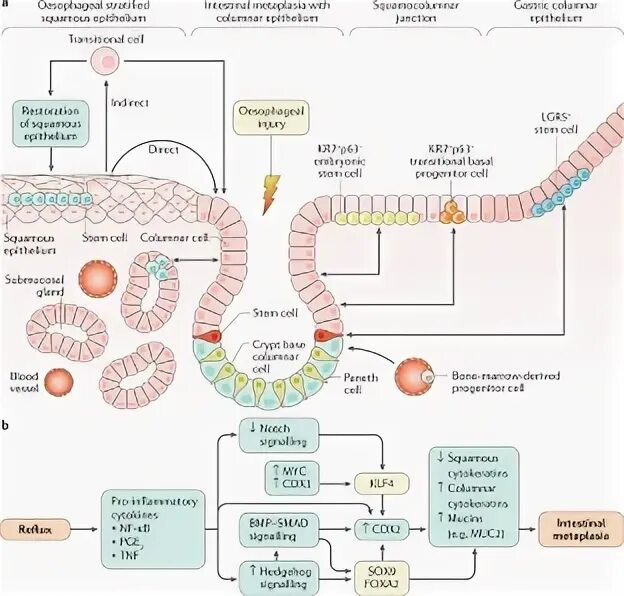 Пищевод Барретта патогенез. Пищевод Барретта гистология. Пищевод Барретта этиология патогенез. Пищевод Баррета патогенез.