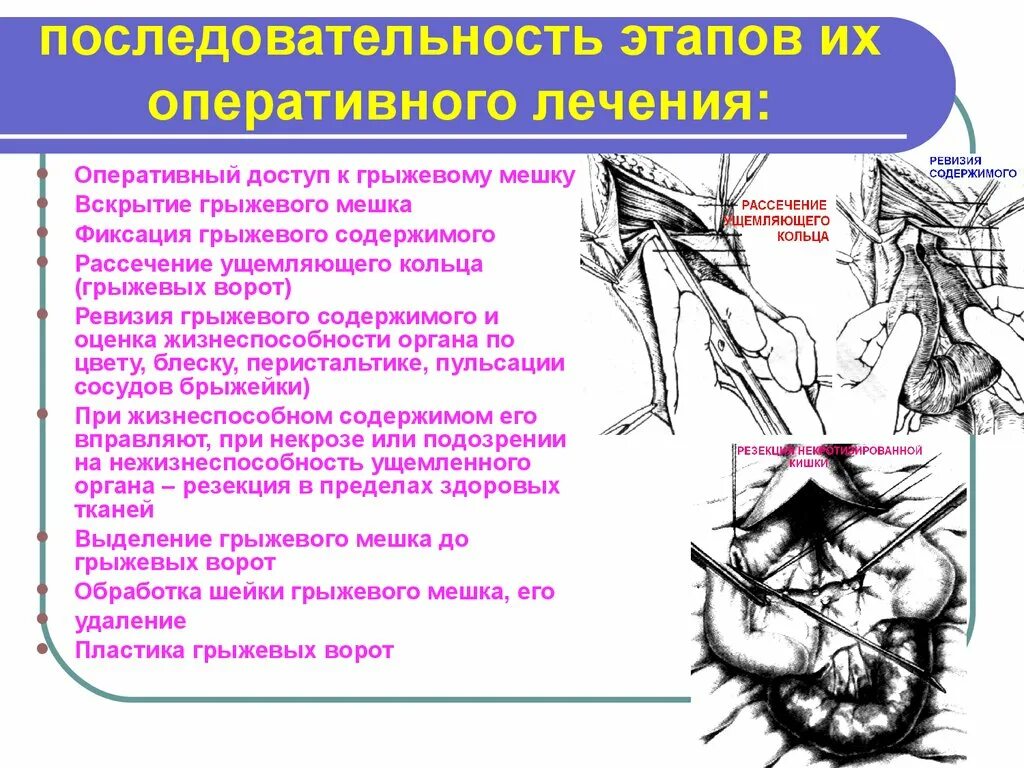 Хирургическая анатомия брюшных грыж. Операции при спинномозговых грыжах топографическая анатомия. Вентральные грыжи этапы операции. Оперативная хирургия грыжа классификация.