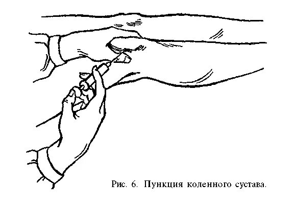 Пункция сустава техника выполнения. Пункция коленного сустава точки пункции. Пункция коленного сустава техника. 6 Точек пункции коленного сустава.