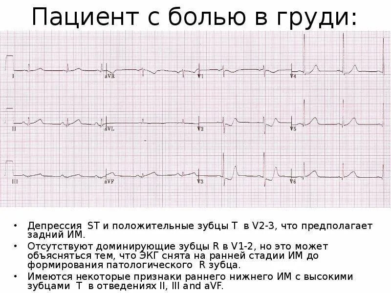 Депрессия сегмента st. Депрессия St v4-v6 ЭКГ. Депрессия сегмента St на ЭКГ типична для. Депрессия St во 2 и 3 отведении. Косонисходящая депрессия сегмента St в v4-v6.