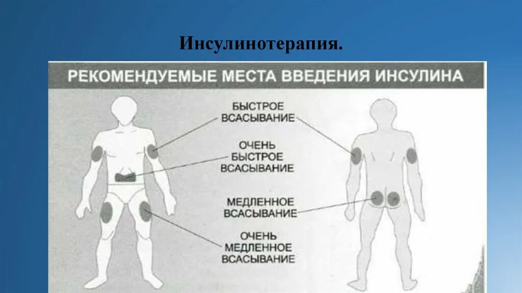 Колем инсулин. Зоны введения инсулина диабетикам. места для инъекции инсулина схема. анатомические области введения инсулина. схема введения инсулина длительного действия.