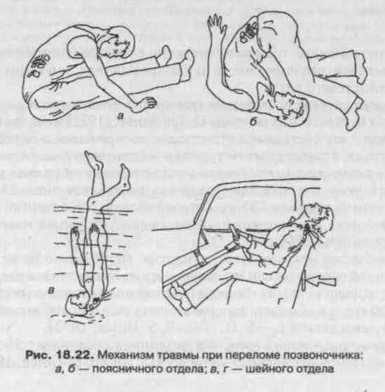 Сгибательный механизм перелома позвоночника. Сгибательный механизм травмы позвоночника. Механизм травмы компрессионного перелома позвоночника. Разгибательный механизм повреждения позвоночника.