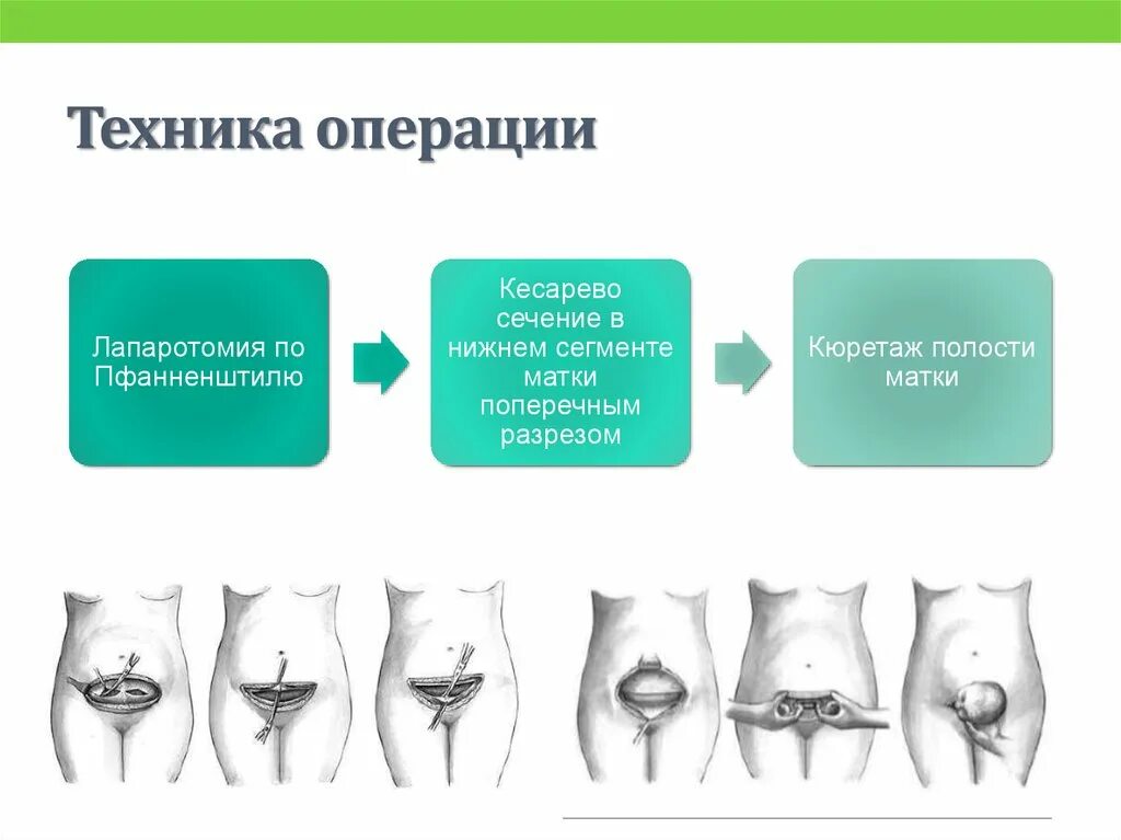 Кесеровое сечение. Методика операции.кесарева сечения. Этапы проведения кесарево сечение. Разрез по Пфанненштилю при кесаревом сечении.