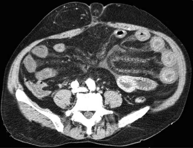 Мезентериальный панникулит мрт. Карциноматоз брюшины на кт что это. Карциноматоз брюшины мрт. Болезнь крона толстой кишки на кт. Инфильтрация брыжейки.