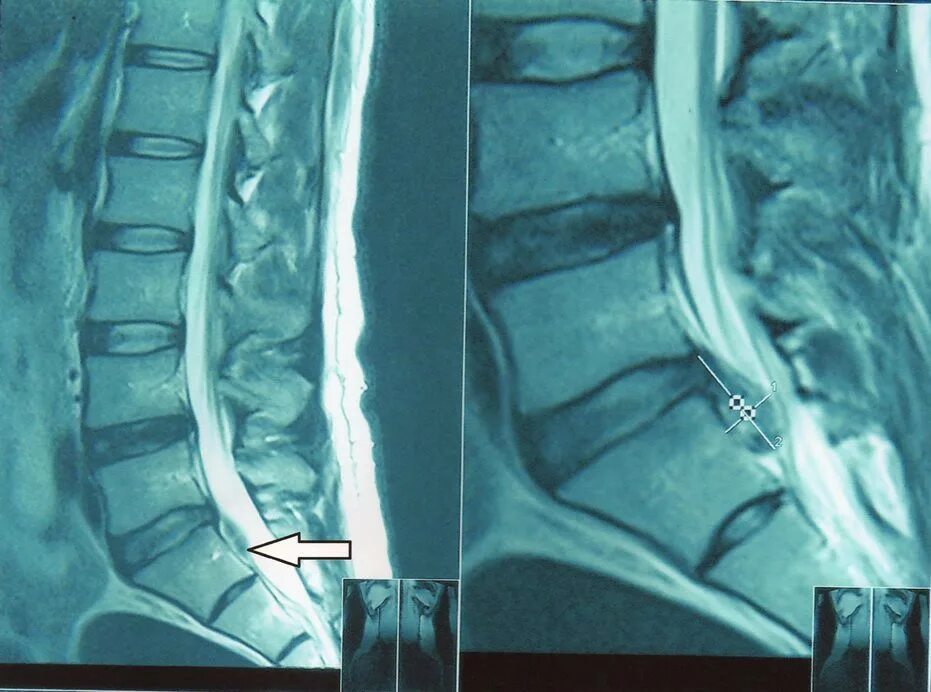 Лечение межпозвоночной грыжи поясничного отдела операция. Межпозвоночная грыжа поясничного отдела мрт. Межпозвонковая грыжа поясничного отдела мрт. Операция на межпозвоночную грыжу поясничного отдела l5-s1.