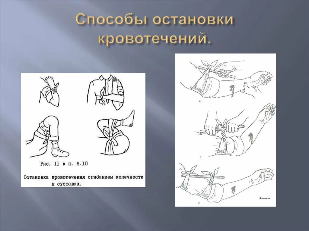 Способы остановки кровотечения лица. Способы остановки кровт. Способы остановки кровотечения. Кровотечение способы остановки кровотечения. Способы остановки кровотечения кратко.