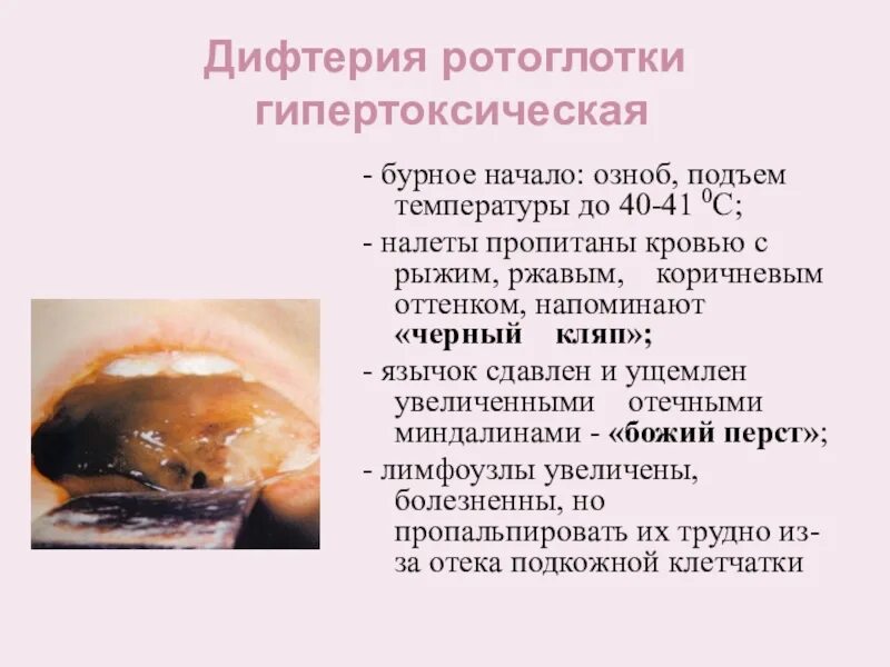 Дифтерия у детей презентация, доклад