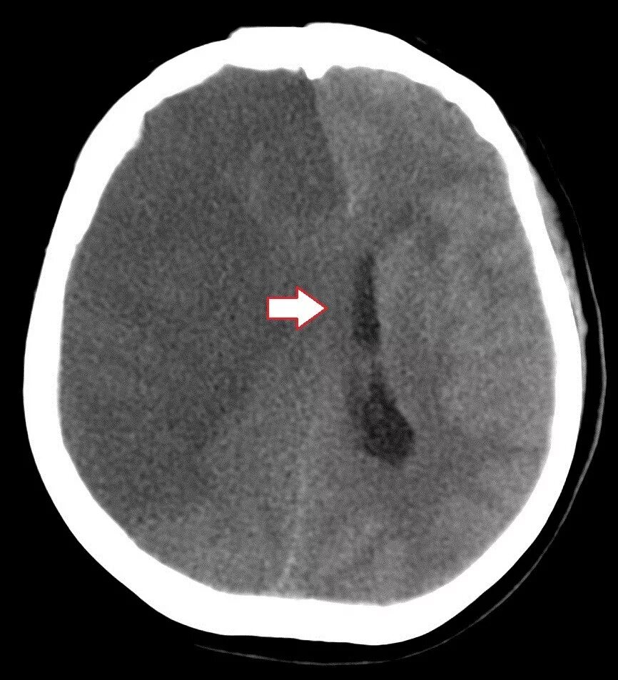 Острый отек мозга. Полушарный ишемический инсульт кт. Обширный ишемический инсульт кт. Отек дислокация головного мозга. Дислокация головного мозга на кт.