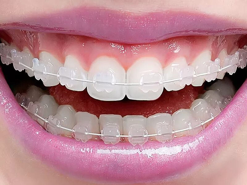 Поставить зубы уфа. Ортодонт люкс калининград ленинский 44. Импланты nobel active. Вкладка культевая что такое в стоматологии. Neodent импланты.