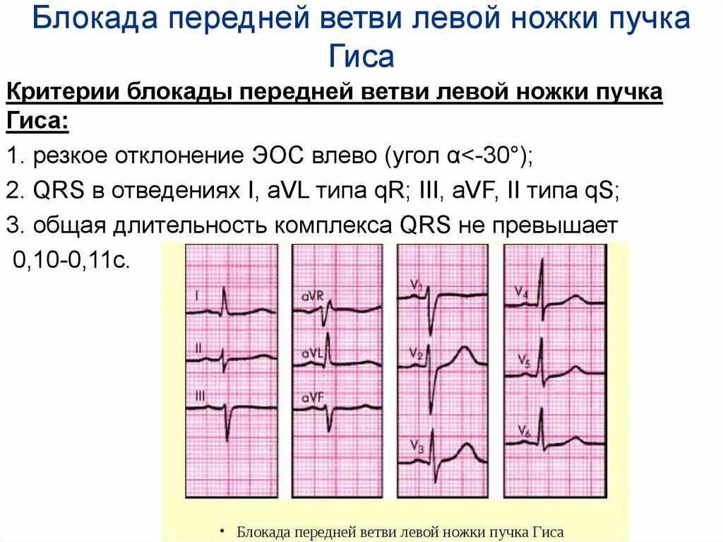 Неполная блокада передней. ЭКГ при блокаде передней ветви левой ножки пучка Гиса (ЛНПГ). Блокада передней ветви ЛНПГ на ЭКГ. Блокада ветвей левой ножки пучка Гиса на ЭКГ. Блокада передне-верхнего разветвления левой ножки пучка Гиса на ЭКГ.