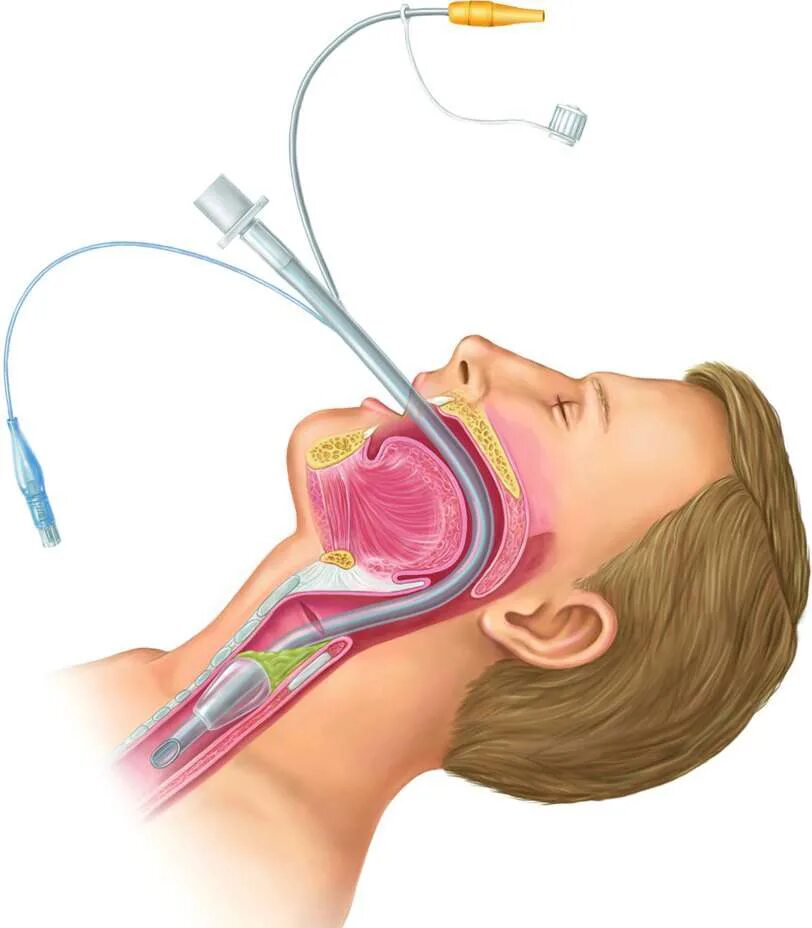 Интубационная трубка ИВЛ. Интубационная анестезия. Интубация эндотрахеальной трубки.