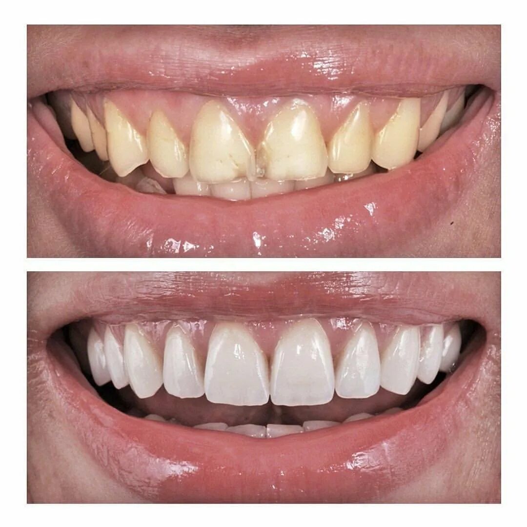 Восстановление передних зубов. Винир реставрация