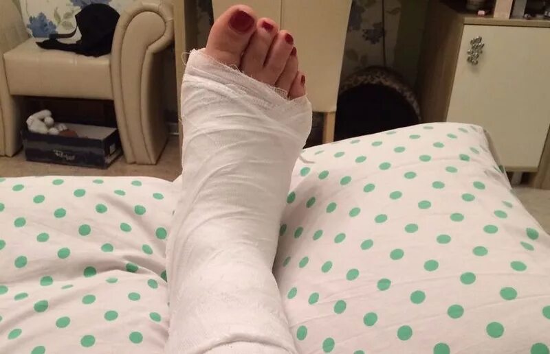 сломанная женская нога