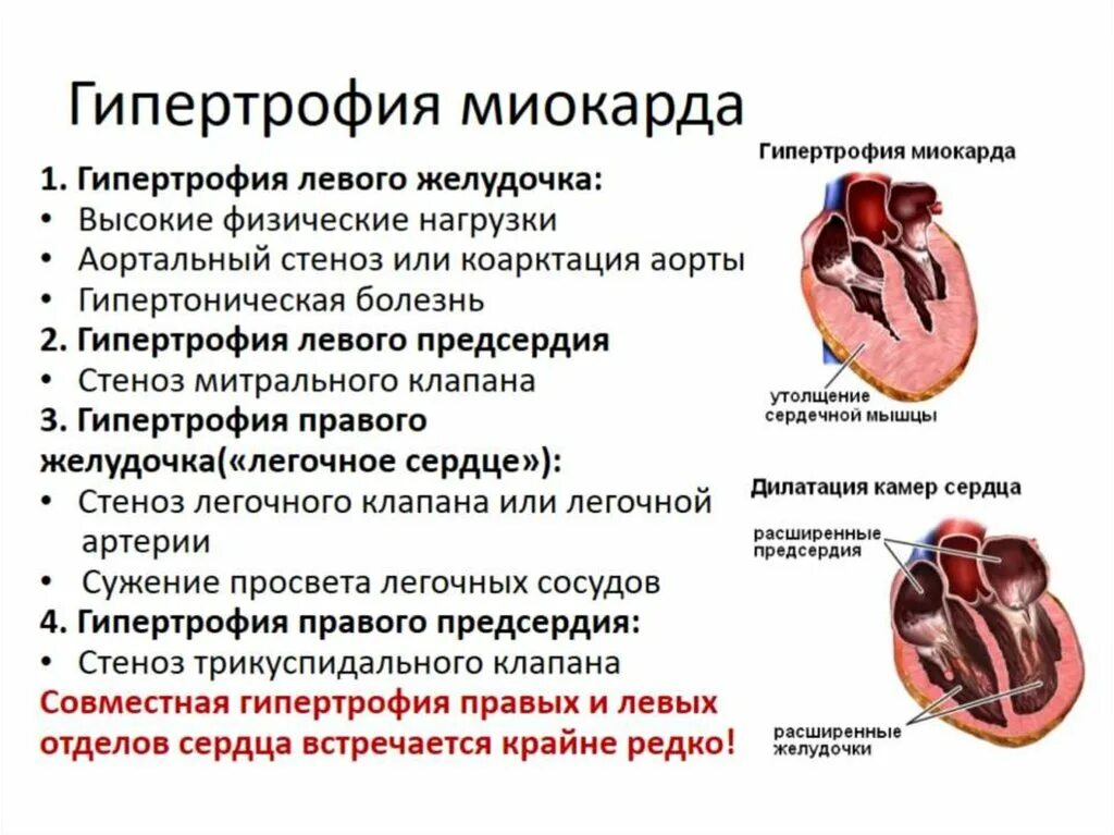 Причины гипертрофии миокарда левого и правого желудочка. Масса миокарда левого желудочка при гипертрофии. Клинические признаки гипертрофии миокарда предсердий. Причины гипертрофии правого желудочка сердца.