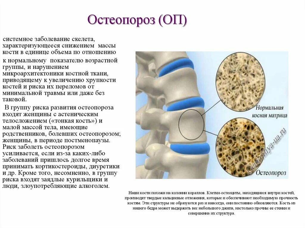Лечение костных заболеваний. Остеопороз. Системный остеопороз.