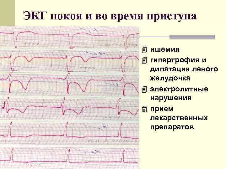 Изменения на ЭКГ при ишемической болезни сердца. Субэндокардиальная ишемия на ЭКГ. Ишемия миокарда на ЭКГ. Ишемия задней стенки сердца на ЭКГ.