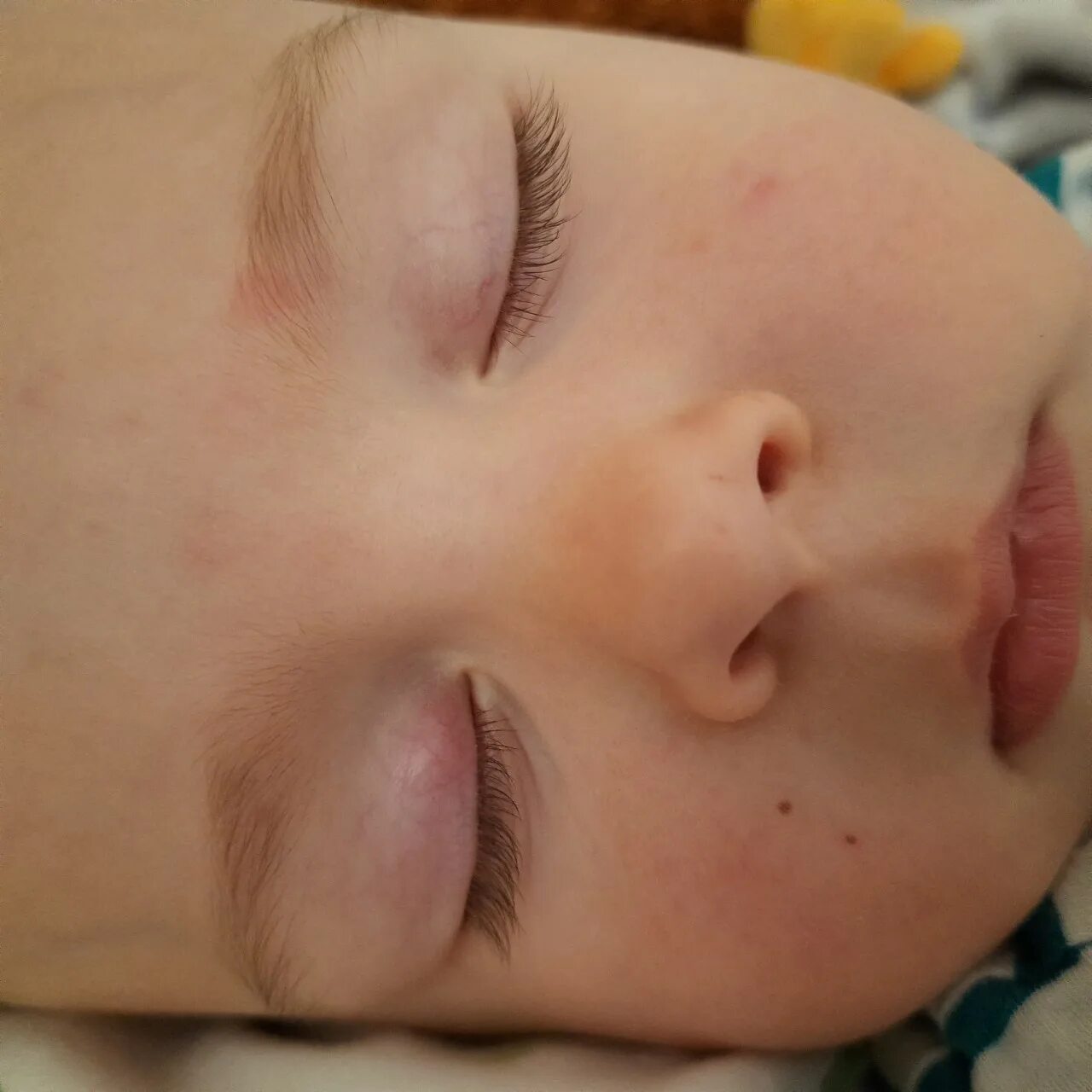 Шишечка на веке у ребенка. Шишка под верхним веком. У ребенка на верхнем веке. Шишка на верхнем веко у ребенка. Шишечка на веке у ребенка.