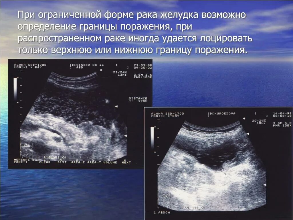 Водно сифонная проба желудка. Водно-сифонная проба УЗИ. Образование желудка на УЗИ. УЗИ желудка водно-сифонная проба.