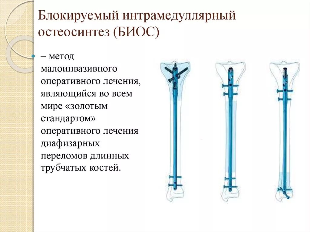 Интрамедуллярный (внутрикостный) остеосинтез. Остеосинтез костей голени. Интрамедуллярный блокируемый остеосинтез. Остеосинтез большеберцовой кости штифтом.