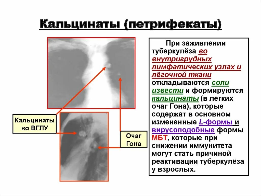 Кальцинаты в лимфоузлах. Кальцинаты туберкулеза рентген. Кальцинированные лимфатические узлы рентген. Кальцинат в лимфоузле при туберкулезе.