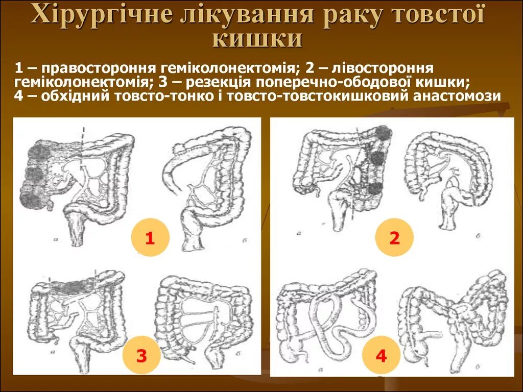 Опухоль толстой кишки локализации. Правосторонняя гемиколэктомия с илеотрансверзоанастомозом. Микулича резекция Толстого кишечника. Лапароскопическая резекция толстой кишки. Симптомы операция кишечнике