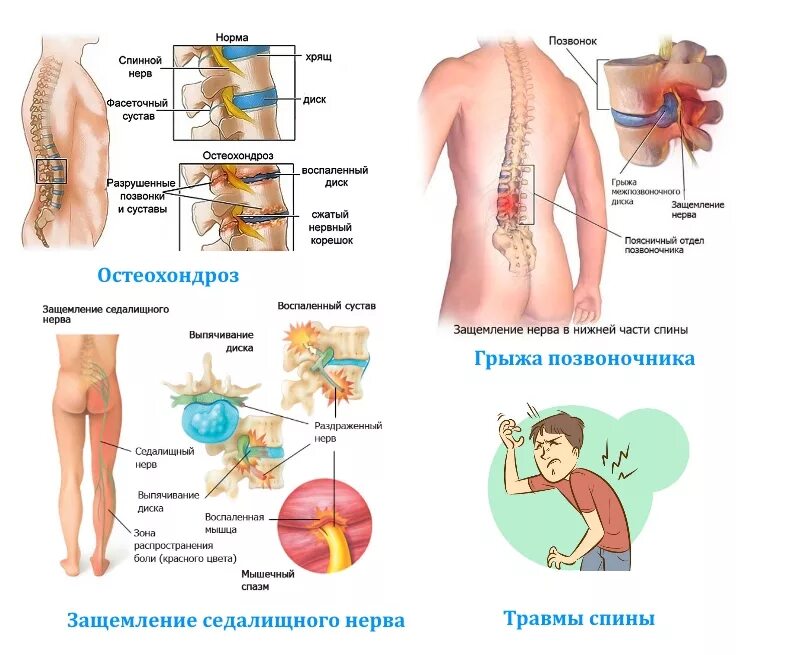 Схема боли в спине. Боли в спине уколы. Уколы при болях в позвоночнике. Болит поясница уколы. Уколы при болях в спине и пояснице.