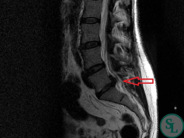 Грыжа диска l5 s1 что это. Грыжа l5-s1. Грыжа диска l5-s1. Радикулопатия l5-s1. Левосторонняя радикулопатия l5-s1.