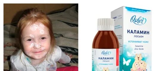 Сколько дней мазать каламином