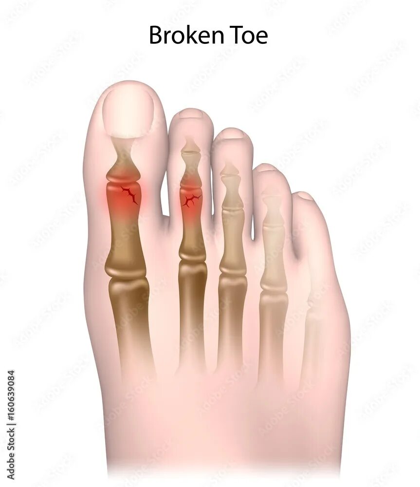 Broken toe Иллюстрация Stock Adobe Stock