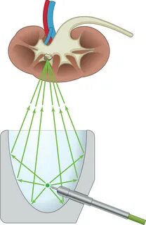 Дробление камней в почках / Статьи - Математическая составляющая
