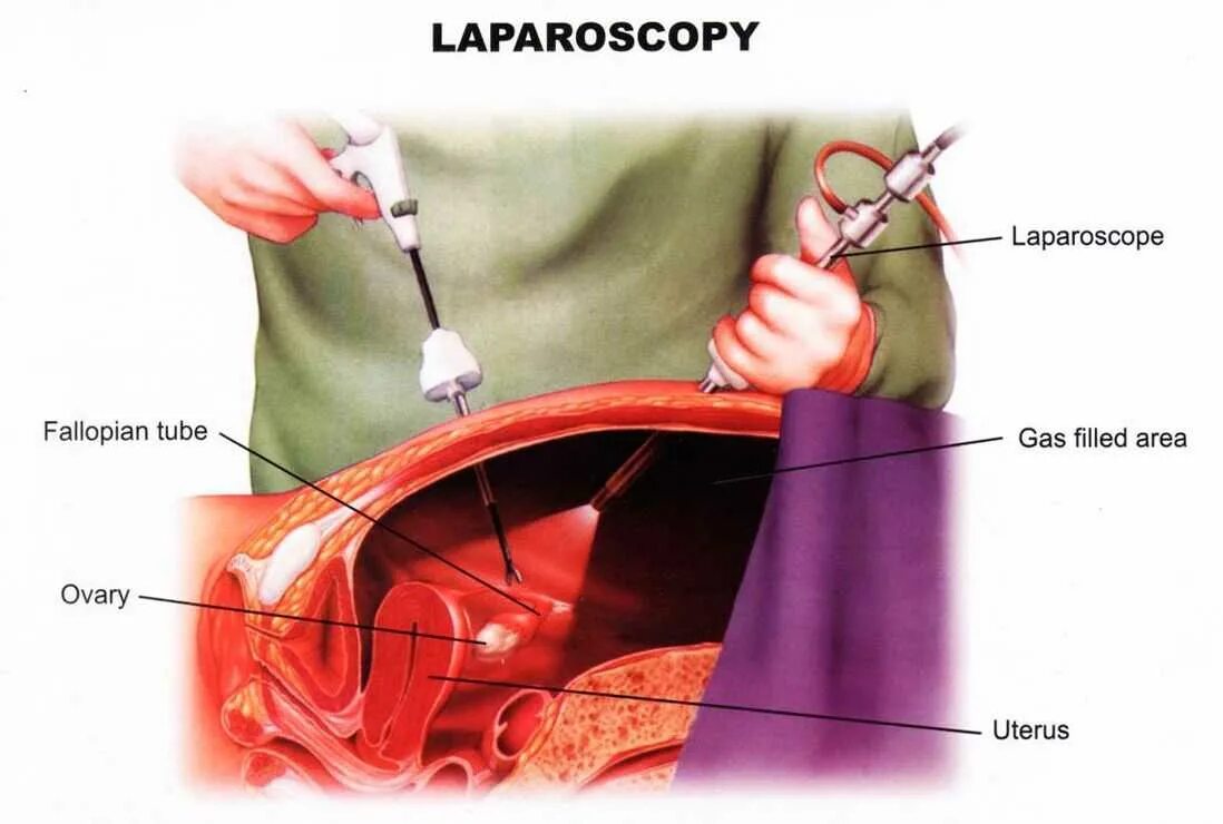 Лапароскопия маточных трубок. Операция внематочной беременности лапароскопии. Лапароскопия непроходимость труб. Операция лапароскопия маточных труб. После удаления матки болит низ живота