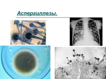 Аспергиллез легких